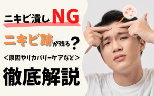 【ニキビ潰しNG】ニキビを潰すと跡が残る！原因やリカバリーケアなど